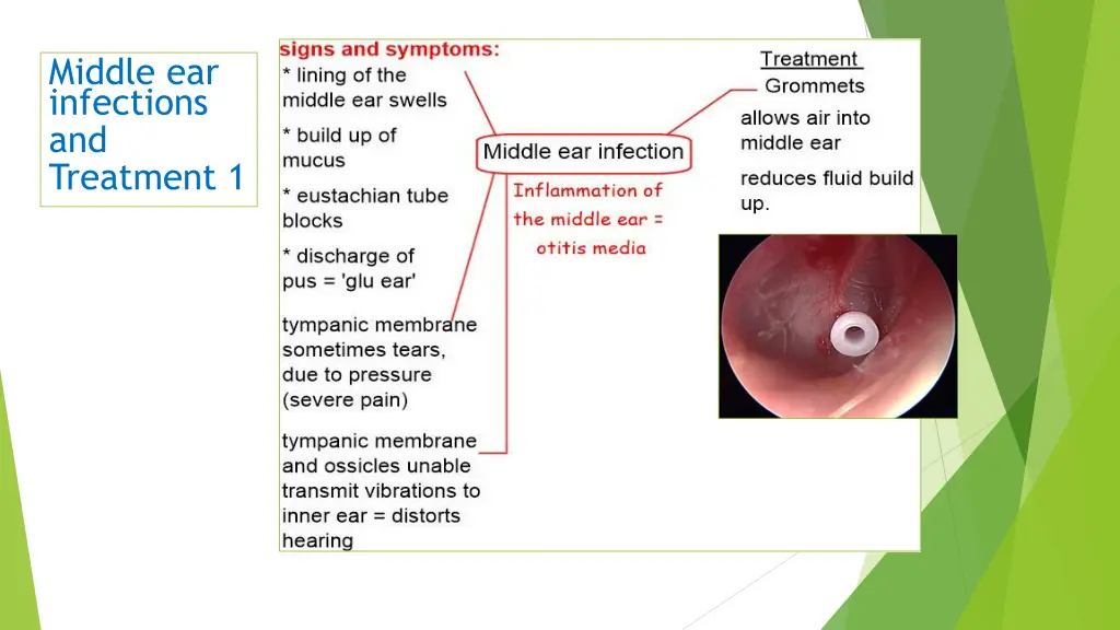 middle ear infections and treatment 1