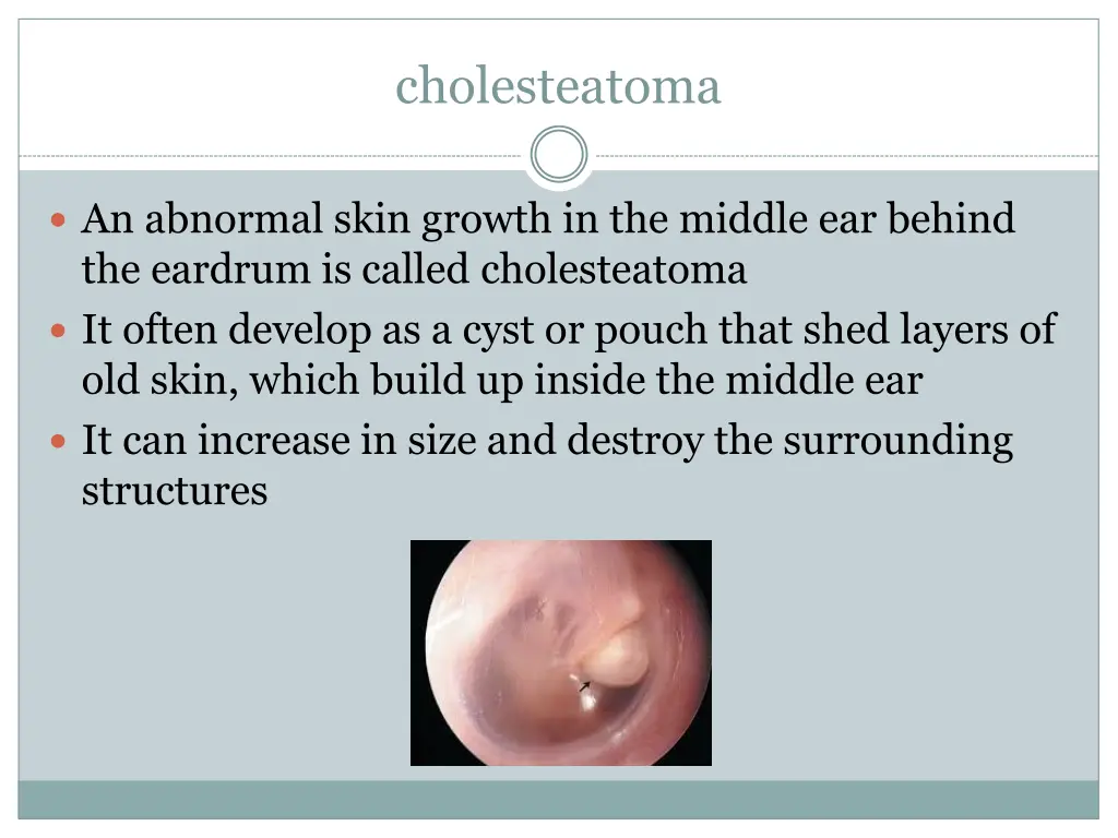 cholesteatoma