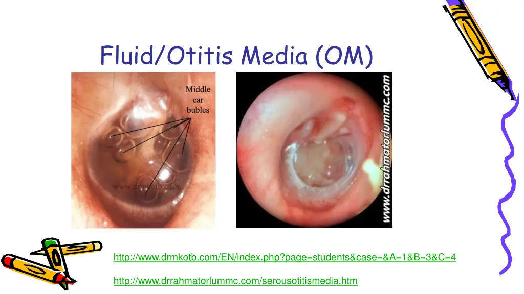 fluid otitis media om