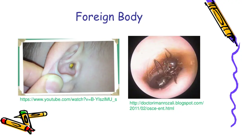 foreign body