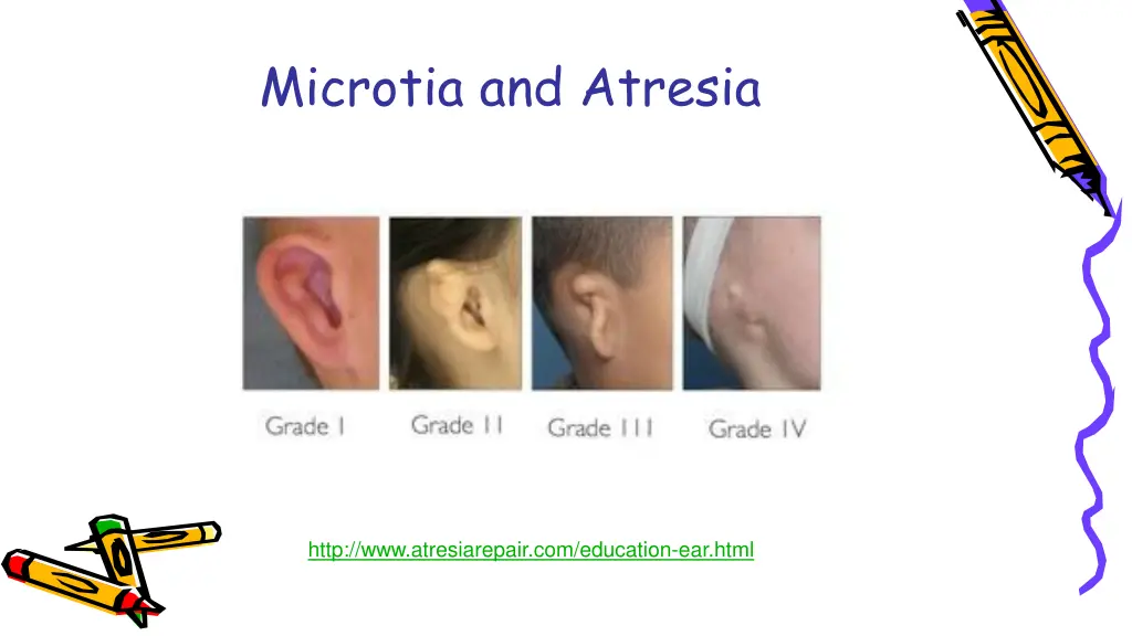 microtia and atresia