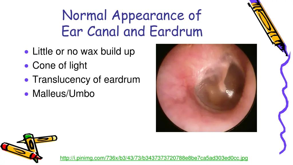 normal appearance of ear canal and eardrum