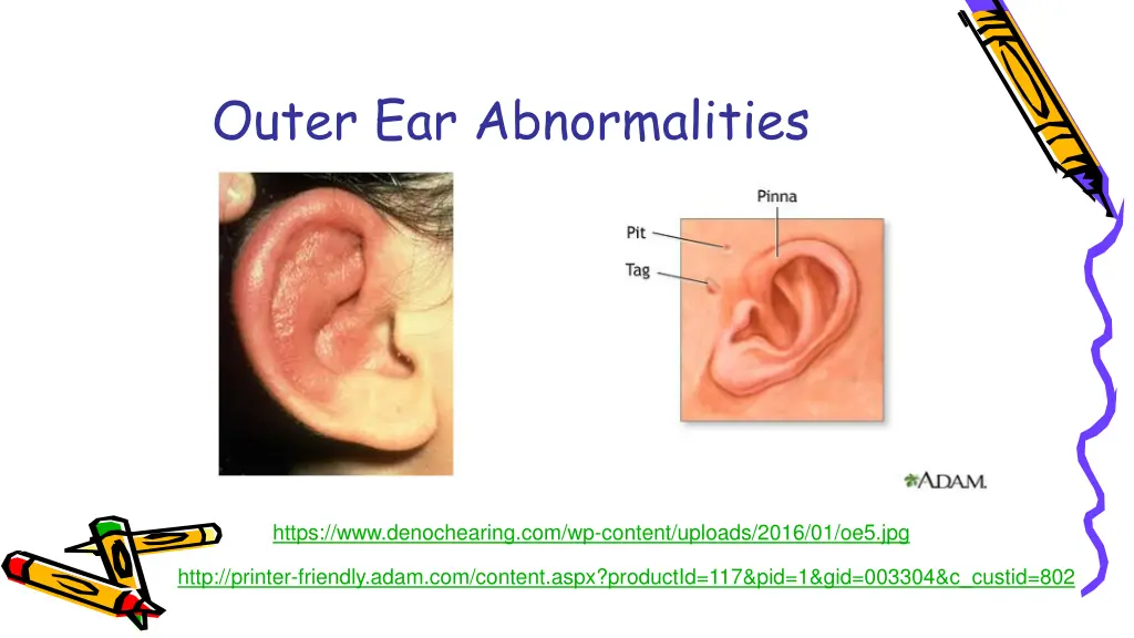 outer ear abnormalities