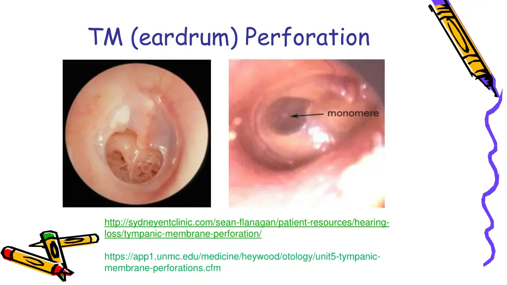 tm eardrum perforation