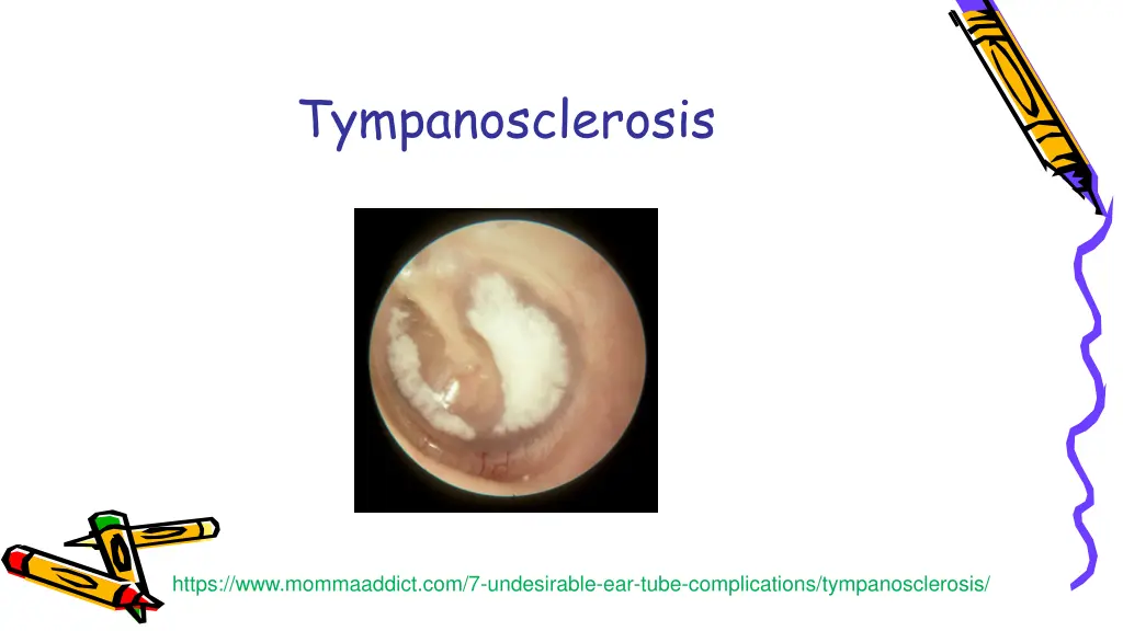 tympanosclerosis