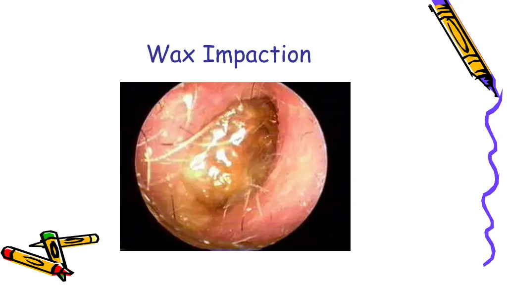 wax impaction