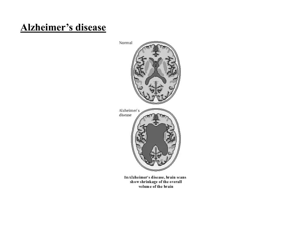 alzheimer s disease