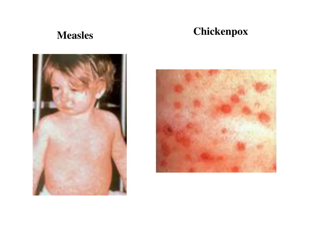 chickenpox