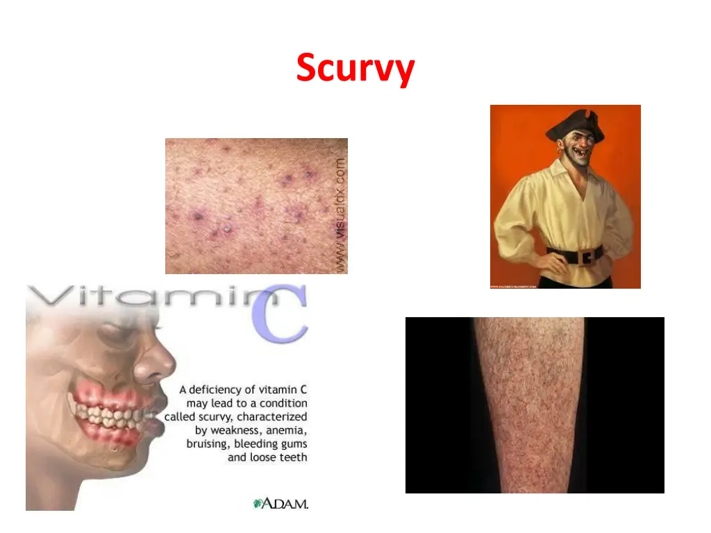 scurvy