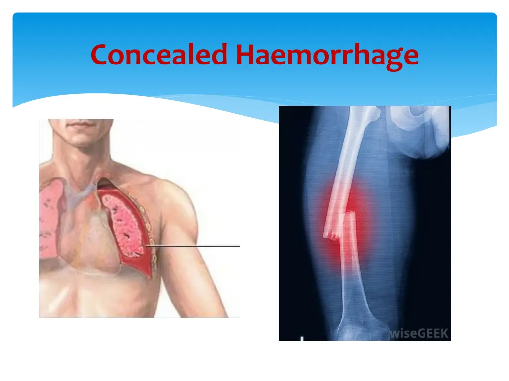 concealed haemorrhage 1