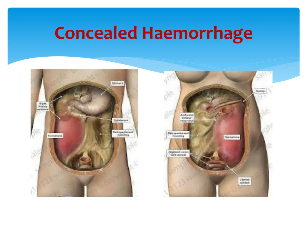 concealed haemorrhage