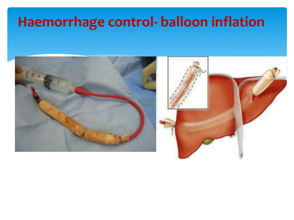 haemorrhage control balloon inflation