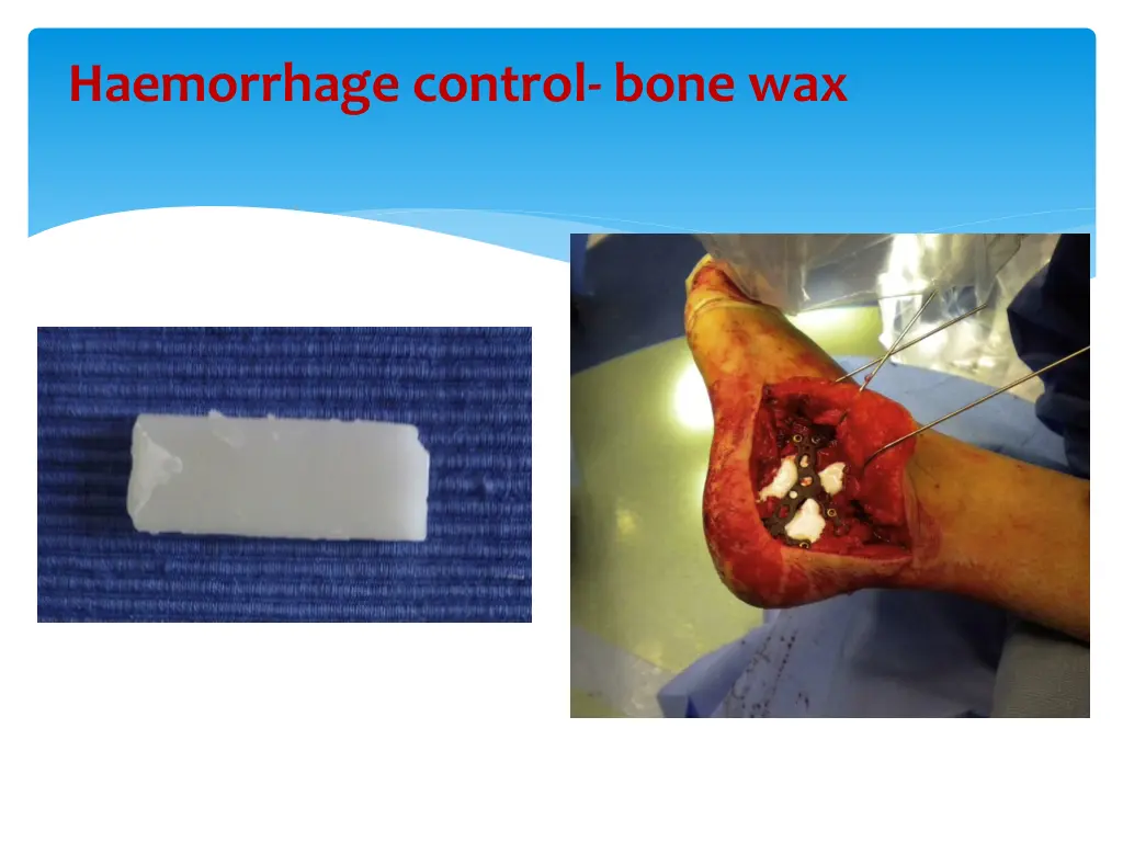 haemorrhage control bone wax