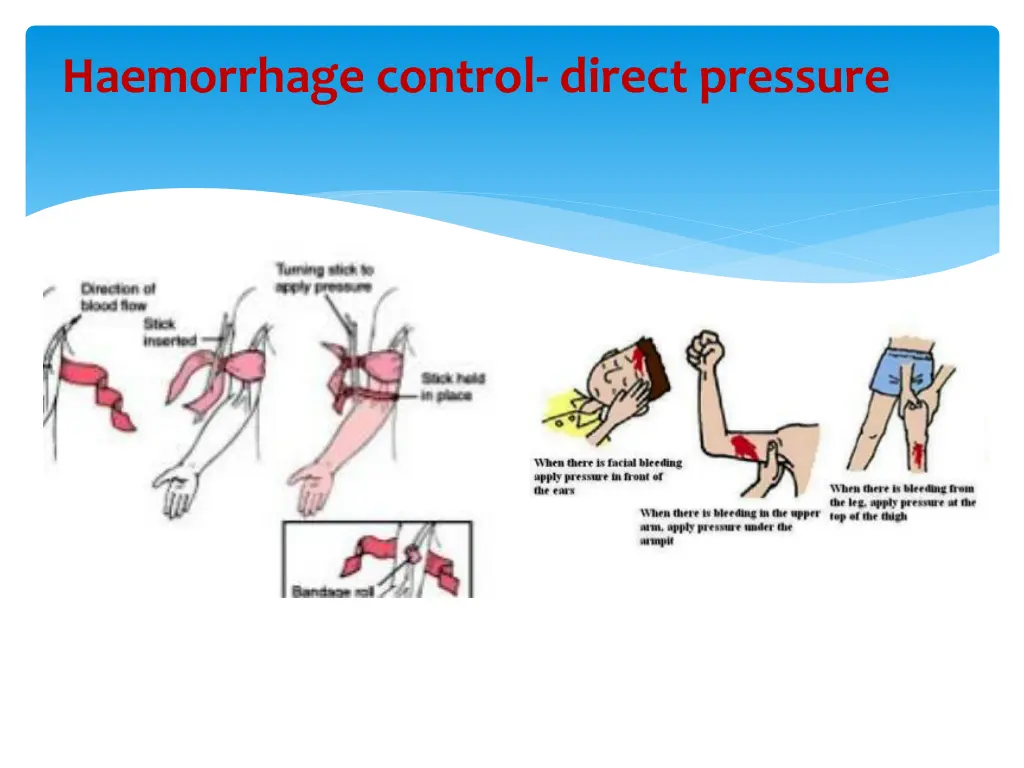 haemorrhage control direct pressure 1