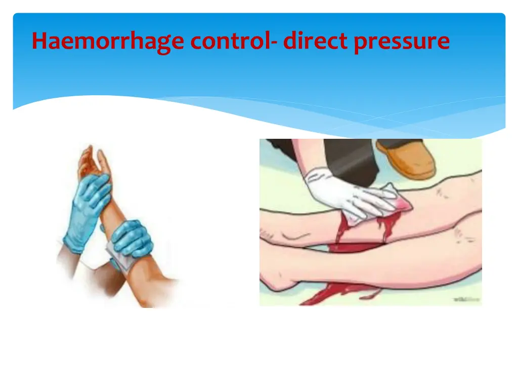 haemorrhage control direct pressure