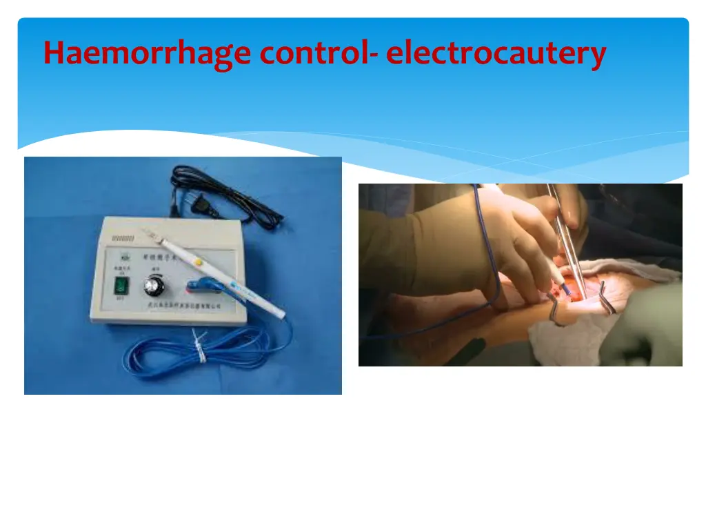 haemorrhage control electrocautery