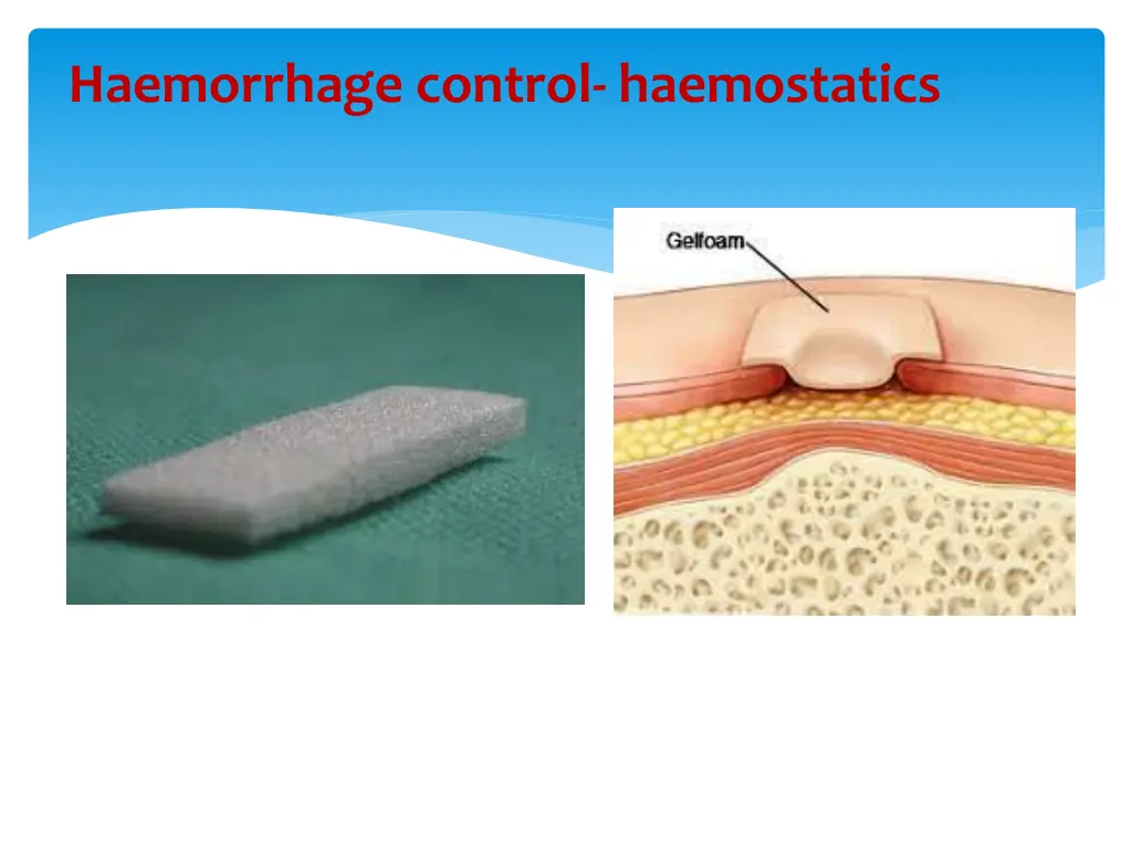 haemorrhage control haemostatics