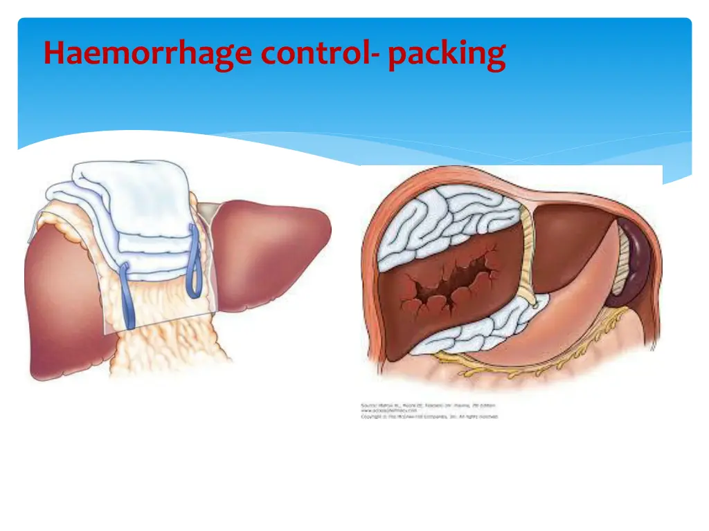 haemorrhage control packing 1