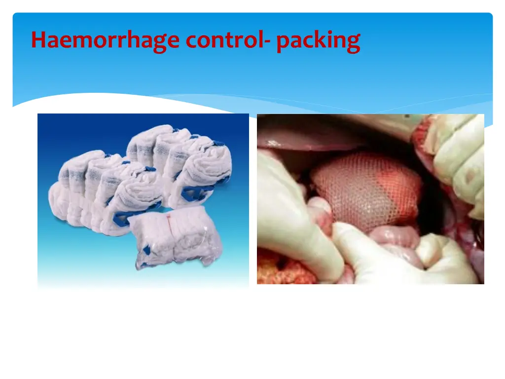 haemorrhage control packing