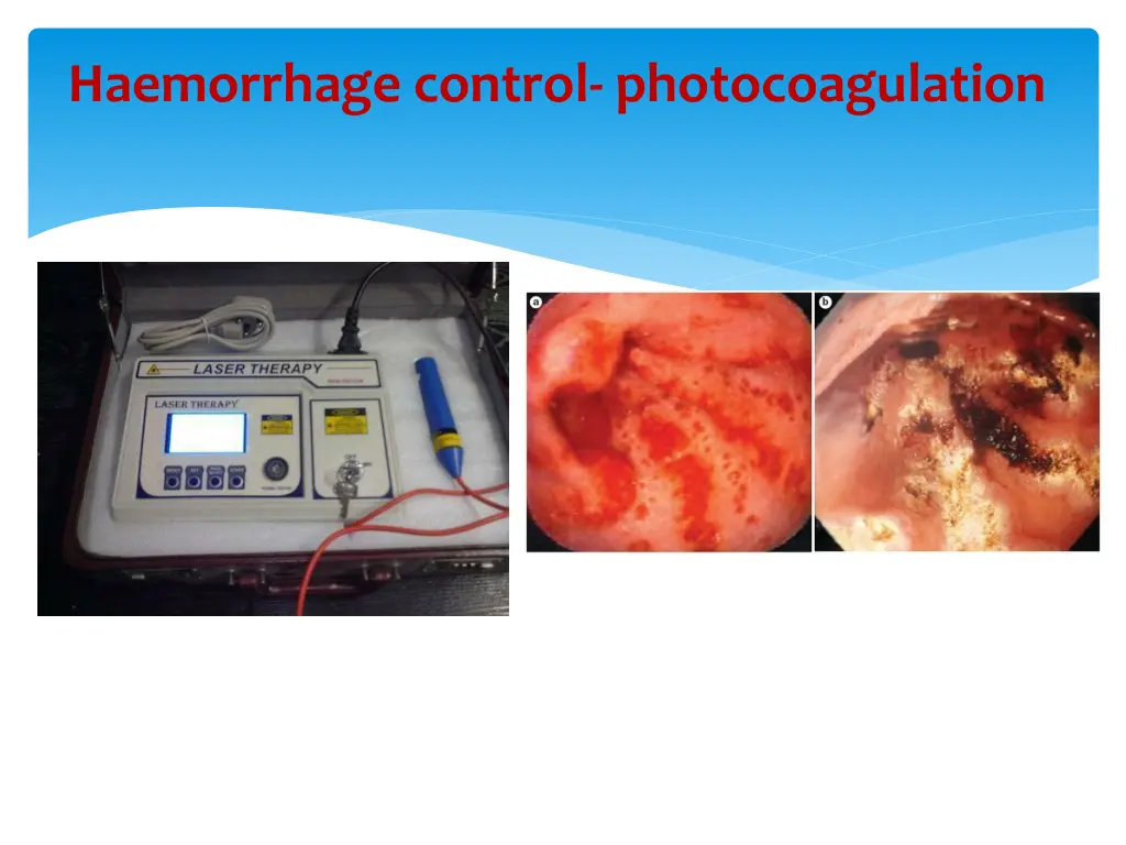 haemorrhage control photocoagulation