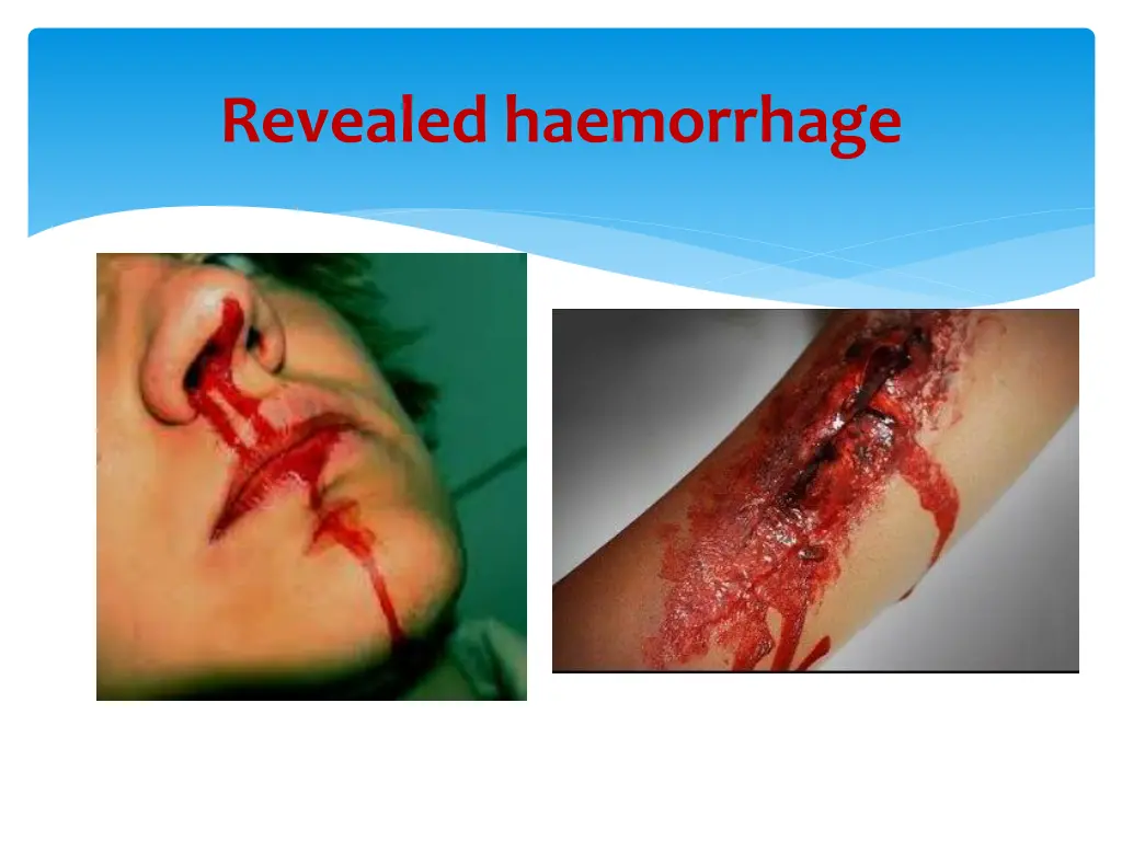 revealed haemorrhage