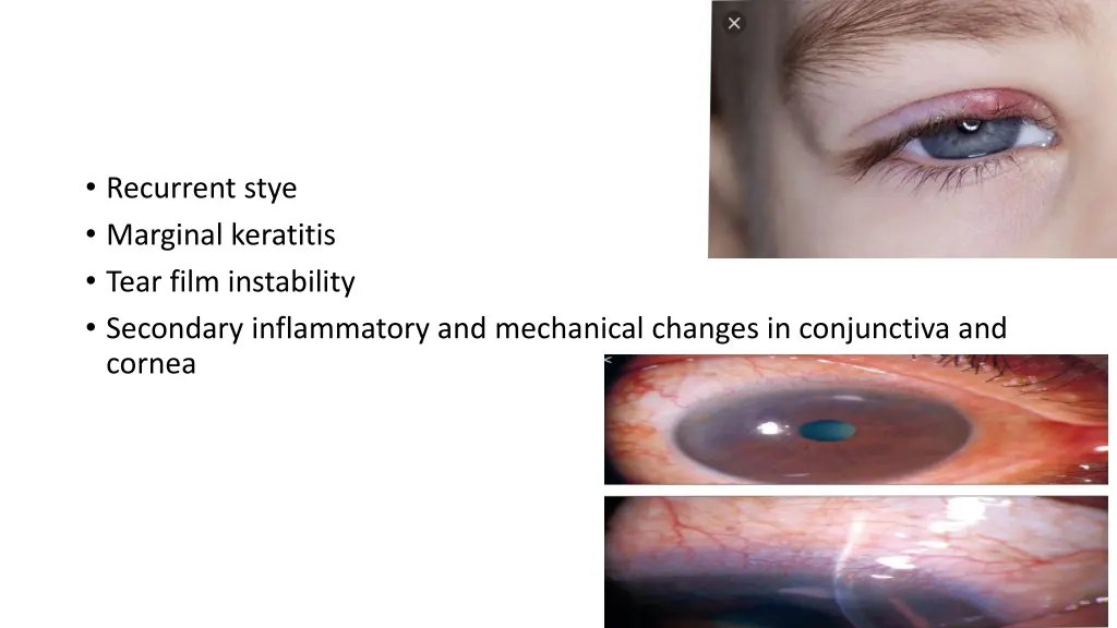 recurrent stye marginal keratitis tear film