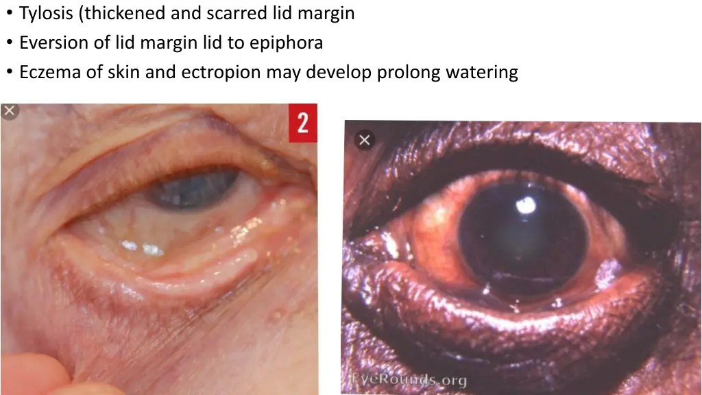 tylosis thickened and scarred lid margin eversion