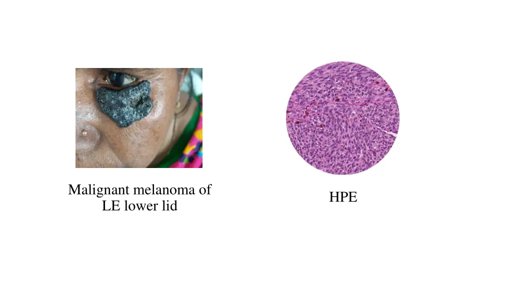 malignant melanoma of le lower lid