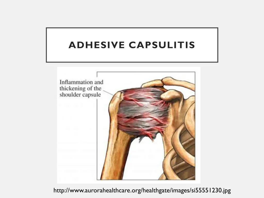 adhesive capsulitis