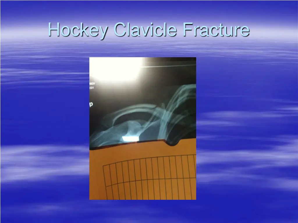 hockey clavicle fracture