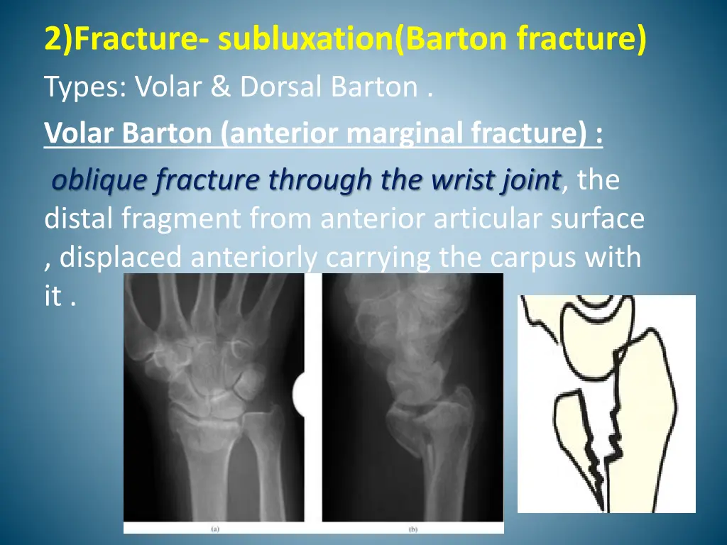 2 fracture subluxation barton fracture types