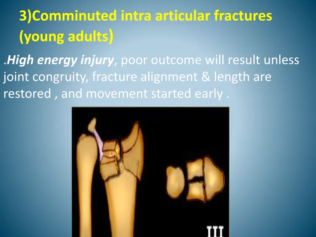 3 comminuted intra articular fractures young