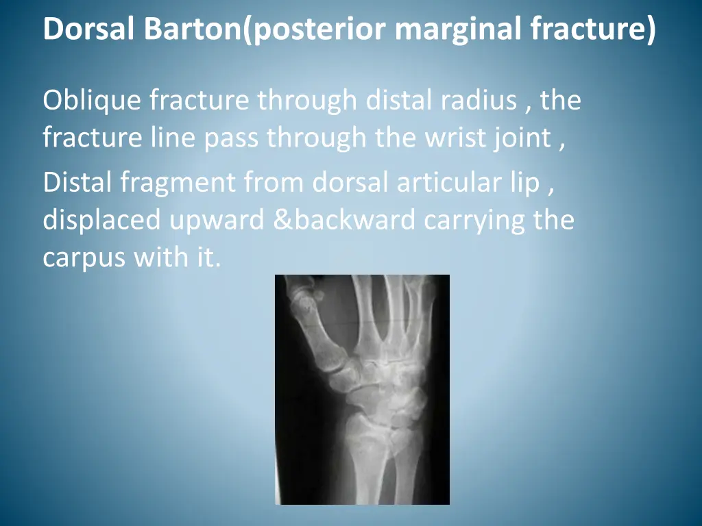 dorsal barton posterior marginal fracture