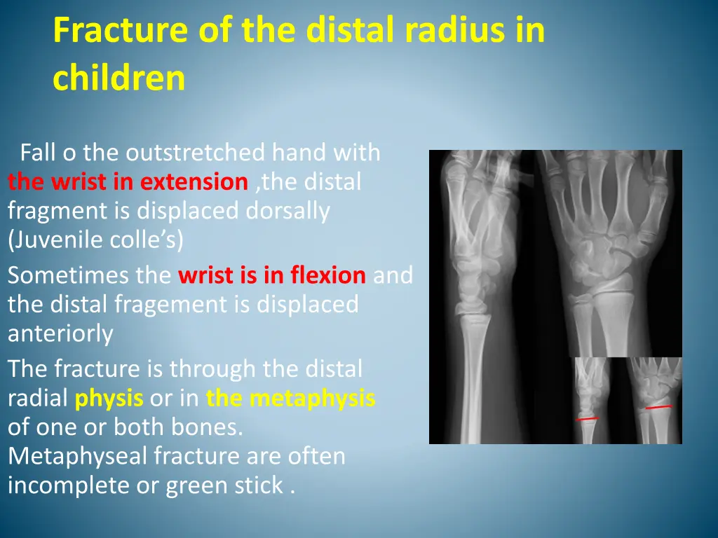 fracture of the distal radius in children