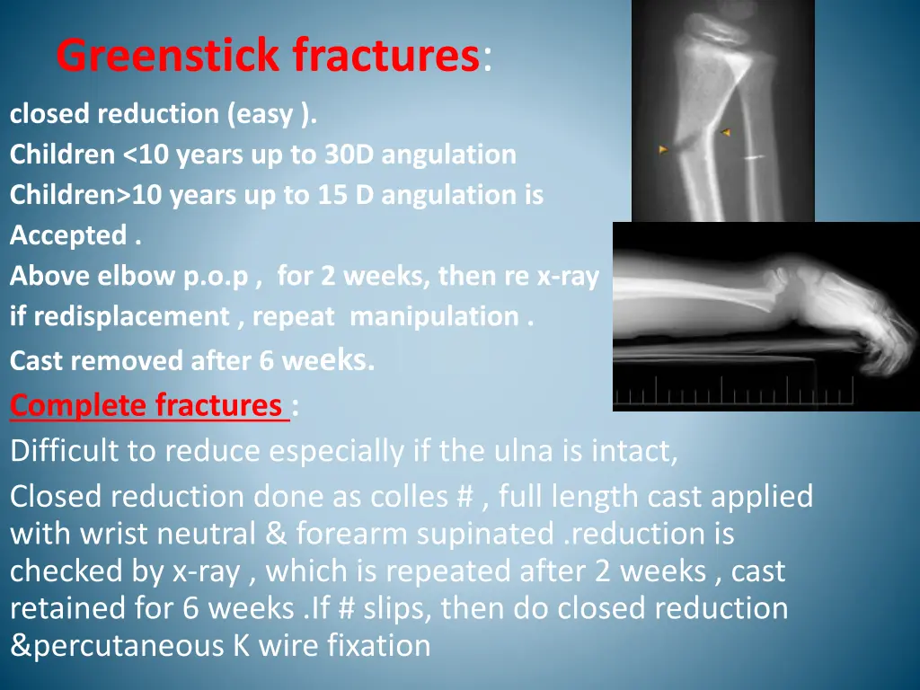 greenstick fractures