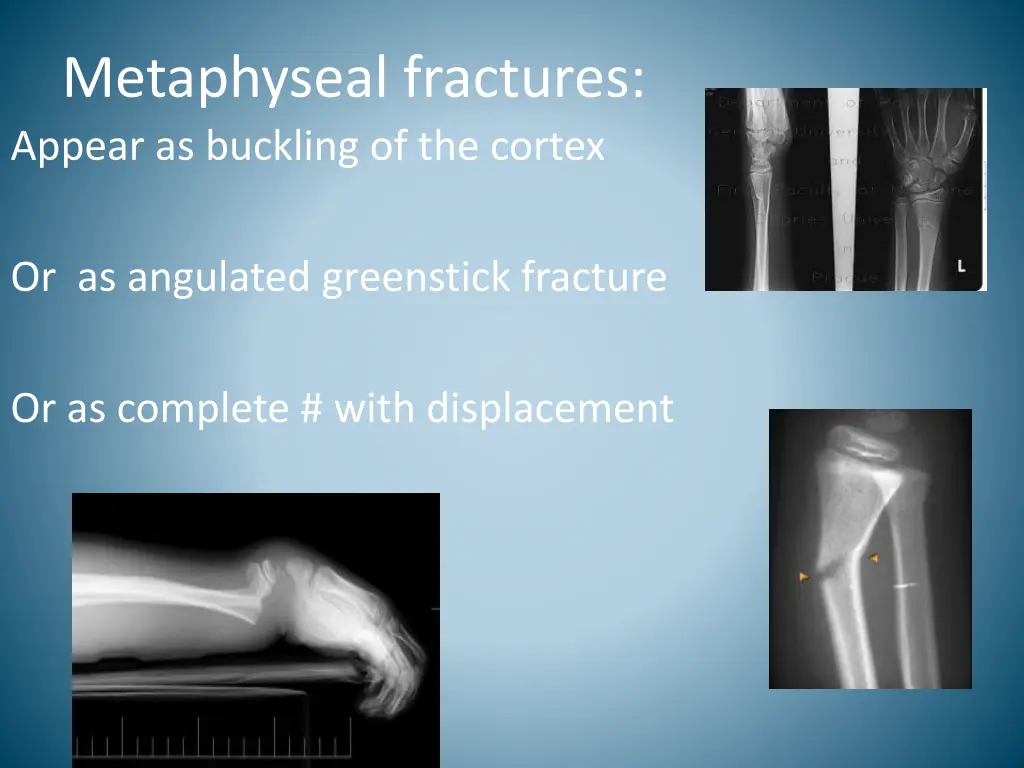 metaphyseal fractures appear as buckling