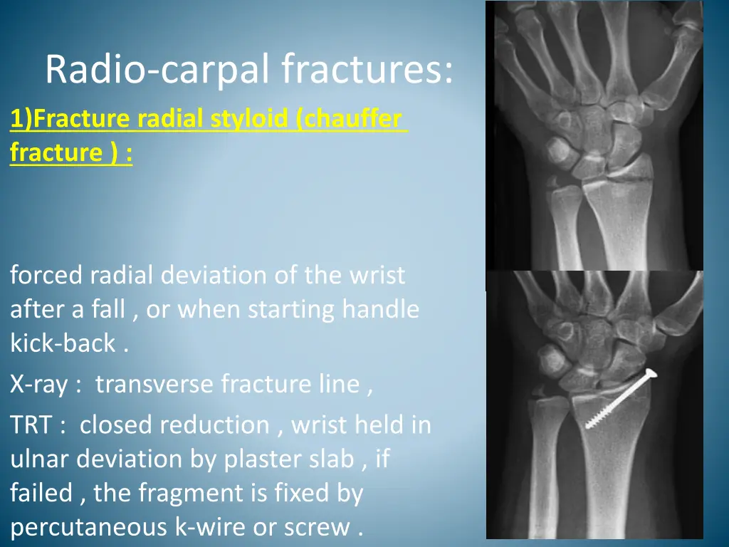 radio carpal fractures 1 fracture radial styloid