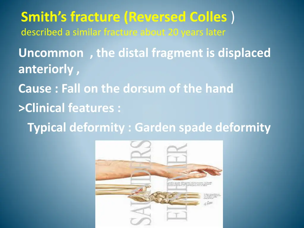 smith s fracture reversed colles described