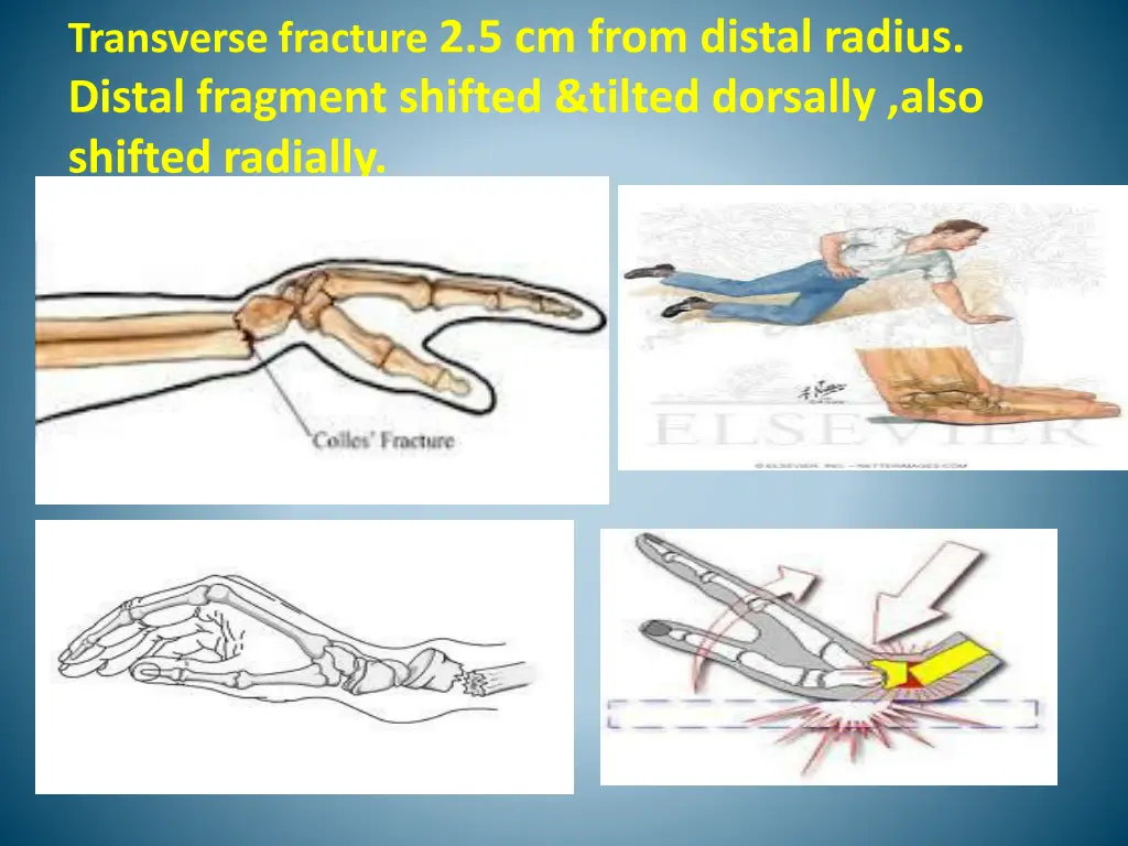 transverse fracture 2 5 cm from distal radius