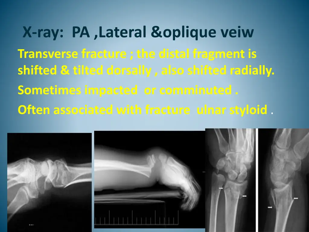 x ray pa lateral oplique veiw transverse fracture