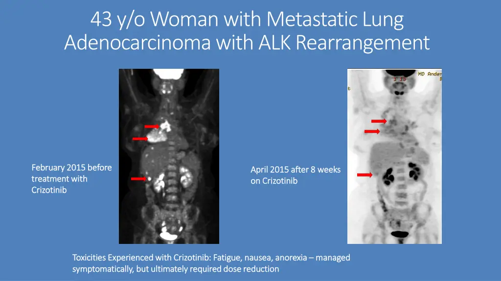 43 y o woman with metastatic lung adenocarcinoma 1