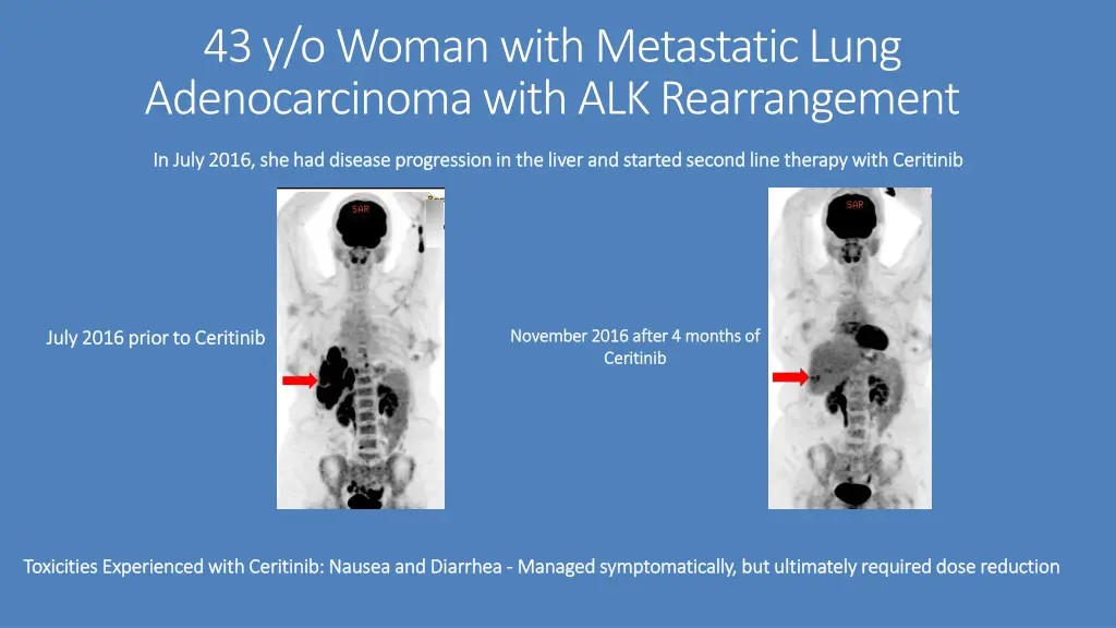 43 y o woman with metastatic lung adenocarcinoma 2