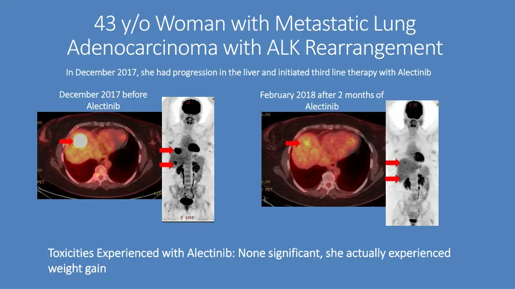 43 y o woman with metastatic lung adenocarcinoma 3