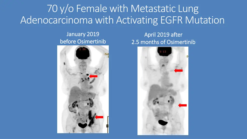 70 y o female with metastatic lung adenocarcinoma 2