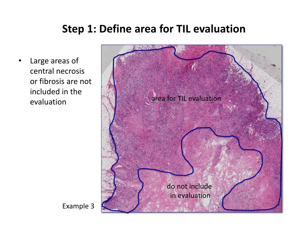 step 1 define area for til evaluation 1