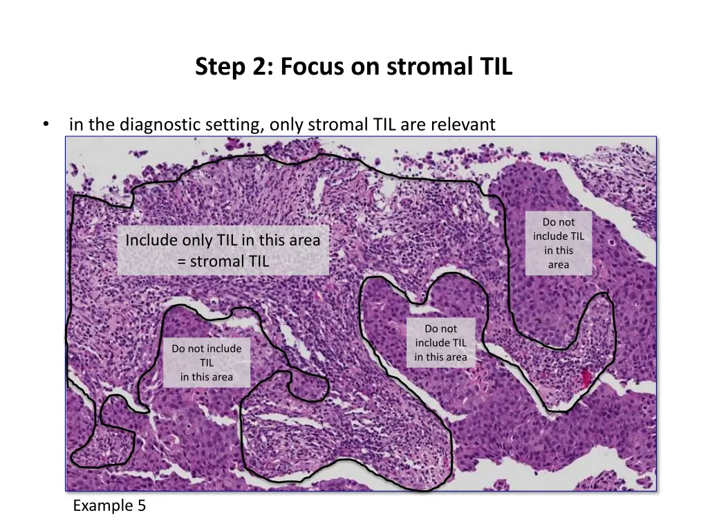 step 2 focus on stromal til 1