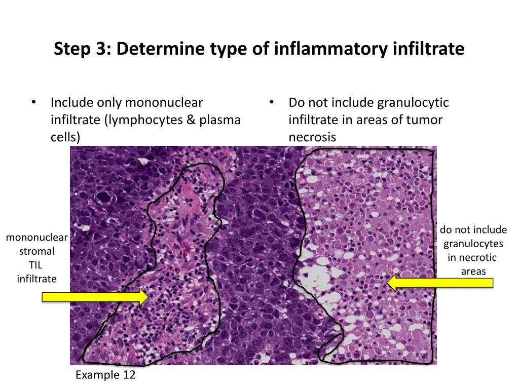 step 3 determine type of inflammatory infiltrate