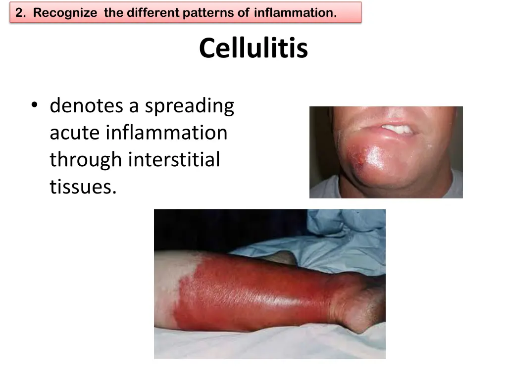 2 recognize the different patterns of inflammation 10