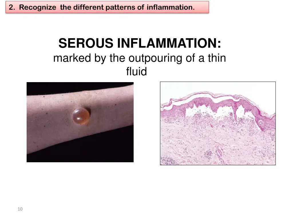 2 recognize the different patterns of inflammation 2