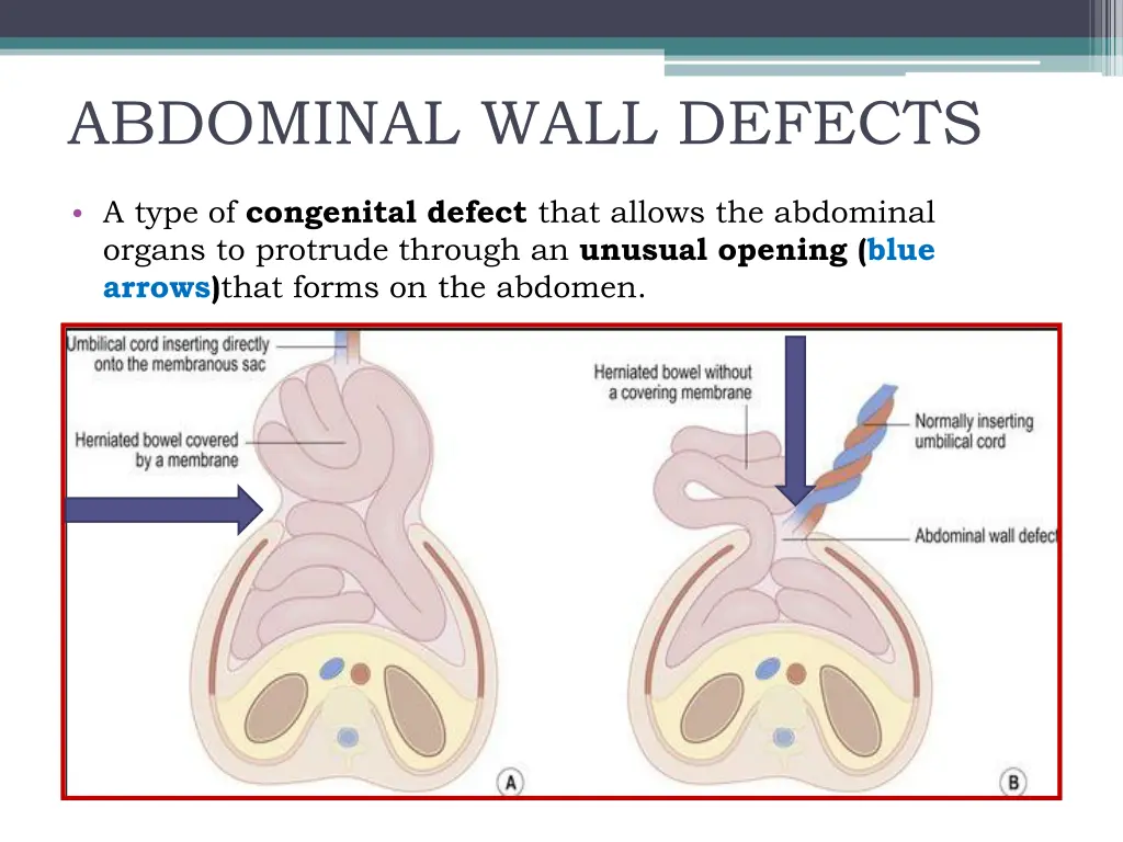 abdominal wall defects